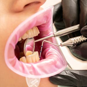 chirurgia mucogengivale - terapia - Padova Dental Clinic