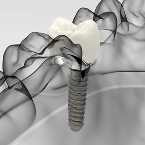 implantologia - terapia - Padova Dental Clinic